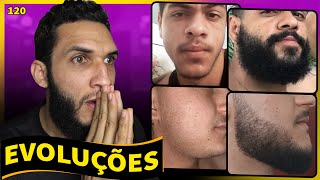 EVOLUÇÕES COM MINOXIDIL resultados dos inscritos 120 [upl. by Sedgewinn]