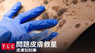 皮膚刮刮樂？但是只有醫生可以刮，請勿模仿！｜問題皮膚救星｜TLC 旅遊生活頻道 [upl. by Ecylahs382]