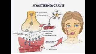 Myasthenia Gravis [upl. by Mannos825]