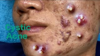 Cystic Acne Blackheads Milia Whiteheads Solution to Pimple Popping [upl. by Samal]