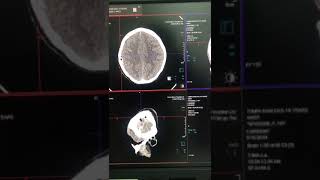 Ct scan of Brain Siemens somatom gotop anatomy [upl. by Acirret]