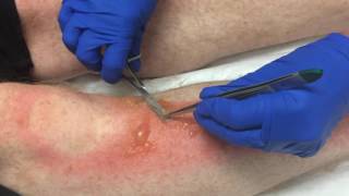 Burns Blister Debridement 2 [upl. by Anali]