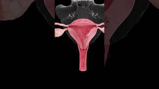 🎗️ Understanding Endometrial Cancer A Growing Concern for Women’s Health 🎗️ [upl. by Vadnee]