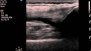 Superior recess effusion  knee joint  MSU ultrasound [upl. by Esilegna87]