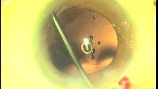 Perfect Capsulotomy Part 1 Femtosecond Laser vs Fugo Plasma Blade [upl. by Airda224]