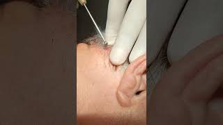 Electrocoagulation of Soft Fibroma on the Scalp [upl. by Sherlock]