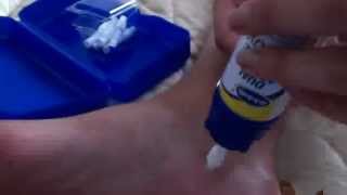 Dr Scholls Dual Action Freeze away wart remover how to for large warts [upl. by Moreno]