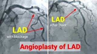 Angioplasty ll Angioplasty procedureRadial access Stenting of LAD हार्ट मैं छल्ला कैसे लगाते है [upl. by Haiel]