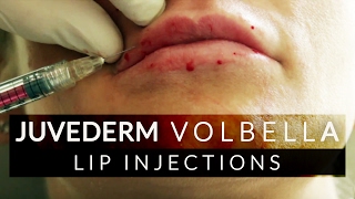 Lip Filler Juvederm Volbella Treatment [upl. by Amzaj549]