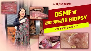 OSMF में कब जरुरी है BIOPSY क्यों करवाए BIOPSY [upl. by Nerak]