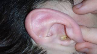 Melting earwax with Otex [upl. by Ehrlich]