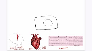 Refeeding Syndrome Explained USMLE [upl. by Otanutrof]