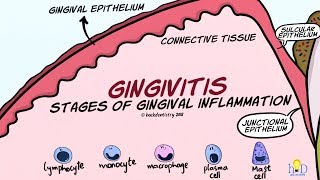 Gingivitis Stages of Gingival Inflammation [upl. by Joela162]