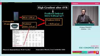 Prosthetic valve high gradient dysfunction or mismatch [upl. by Ahseikram746]