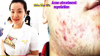 The best blackheads extractionsAcne Treatment at Hien Van Spa390Sú Minh Duy [upl. by Alberic]