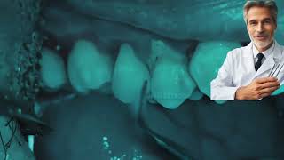 heavy dental tartar removal and some tips [upl. by Inek179]