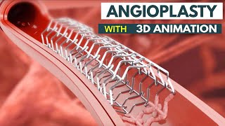 Angioplasty Procedure Explained How It Saves Lives  What Is Angioplasty StepbyStep Explanation [upl. by Tavy]