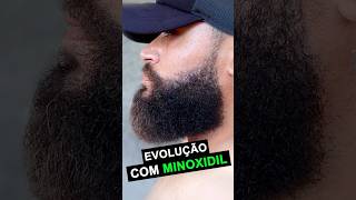 EVOLUÇÃO MINOXIDIL  8 MESES de tratamento minoxidil barba thedicas [upl. by Kapeed]