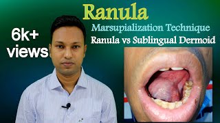 Ranula। How to Marsupialize। Ranula vs Sublingual Dermoid [upl. by Lemert883]