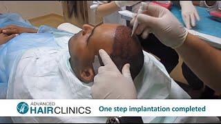 FUE Hair Transplantation StepbyStep by Dr Anastasios Vekris [upl. by Yerxa651]