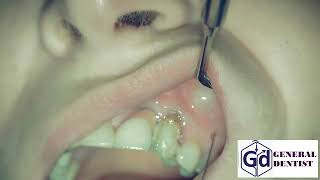 Infiltration anesthesia for treatment tooth 22 [upl. by Nnov]