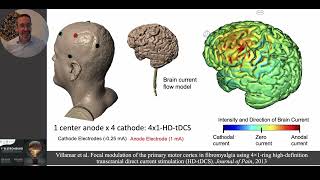 Optimizing brain targeting with HDtDCS how to design tDCS montages for targeted outcomes [upl. by Llirred]