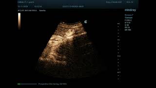 Hemangioma 33 CEUS [upl. by Andi]