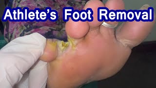 Athletes foot Removal  Fungal skin infection athletefoot [upl. by Otreblide]