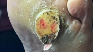 Pedicure video22，vertical plantaris，plantar wart [upl. by Grondin]