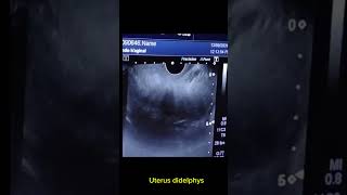 Uterus didelphys with right adnexal haemorrhage cyst [upl. by Siradal]