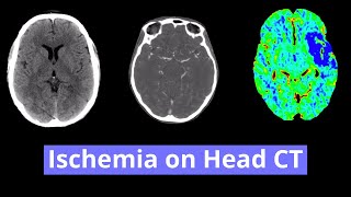 Ischemia on Head CT [upl. by Nereil40]