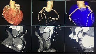 CTA CORONARY  Siemens 128 Somatom goTop  65 ml Contrast flow rate 55 mls HMS MIRDIF HOSPITAL [upl. by Elana]