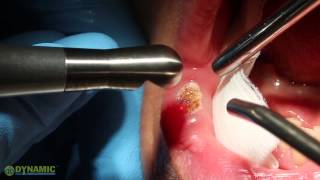 Hemangioma Removal [upl. by Geoffrey]