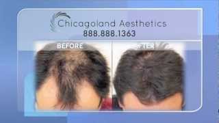 Neograft Hair Transplant in Chicago [upl. by Enrev941]