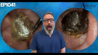 The Most Shocking Ear Wax Removal Youve Never Seen  EP1041 [upl. by Letrice]