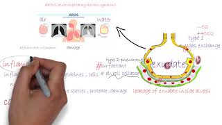 ARDS acute respiratory distress syndromeشرح [upl. by Spielman]