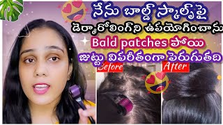 SHOCKING RESULTS 😲✨✨ ఇది Doctors hairgrowth కోసం ఉపయోగిస్తారు ✨ [upl. by Renzo]