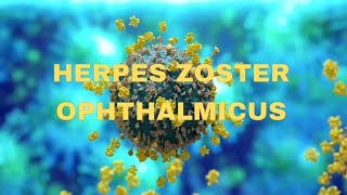 Herpes zoster ophthalmicus  OPHTHALMOLOGY  NEETPG  virus  keratitis [upl. by Worthy]