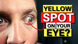 Yellow SPOT On Your Eye  Pinguecula Explained [upl. by Hengel]