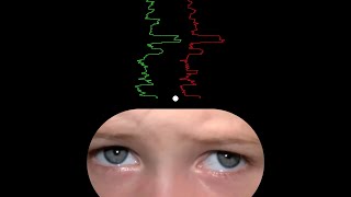 Can this improve Nystagmus visual stability [upl. by Lady]