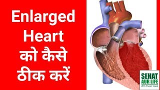 Enlarged Heart को कैसे ठीक करें In Hindi [upl. by Desireah]