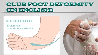 Club Foot DeformityTalipes equinovarusEasy Lecture In English [upl. by Anya755]