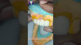 Anterior Teeth  PFM  Ceramic 4 Units  Upper Arch  Tamil Dental Lab  Dentist World  viralvideo [upl. by Arenat]