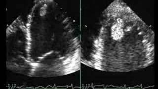 Dilated Cardiomyopathy with Mural Thrombus [upl. by Laverne454]