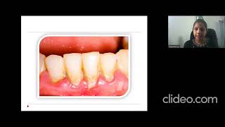 INTERDENTAL CLEANING AIDS DR DIVYASREE  DEPT OF PERIODONTICS ROYAL DENTAL COLLEGE [upl. by Raffaj]