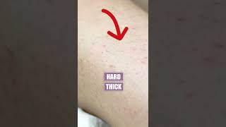 Difference Between Acne And Ingrown Hair [upl. by Yedsnil]