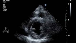 Hypokinesis Mitral Regurgitation Aortic Insufficiency [upl. by Oicinoid391]