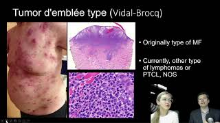 Tumor mycosis fungoides practical approach [upl. by Lyj580]