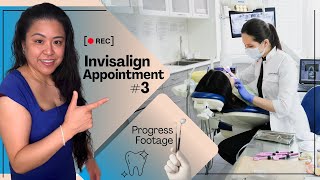 Invisalign Appointment 3 Progress Footage [upl. by Regdor170]