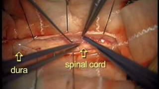 Dr Ali Bydon Performs A Spinal Cord AV Fistula Repair [upl. by Dihaz]